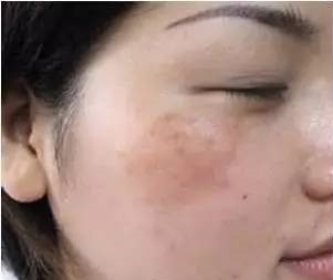 褐斑怎么治用什么药,褐斑如何防治