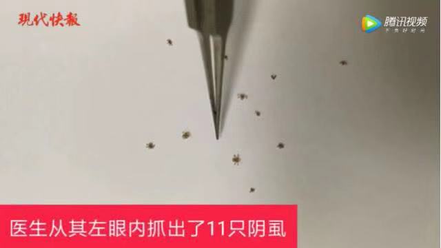 小孩眼睛里长阴虱,4岁小孩睫毛长满阴虱瘙痒难忍