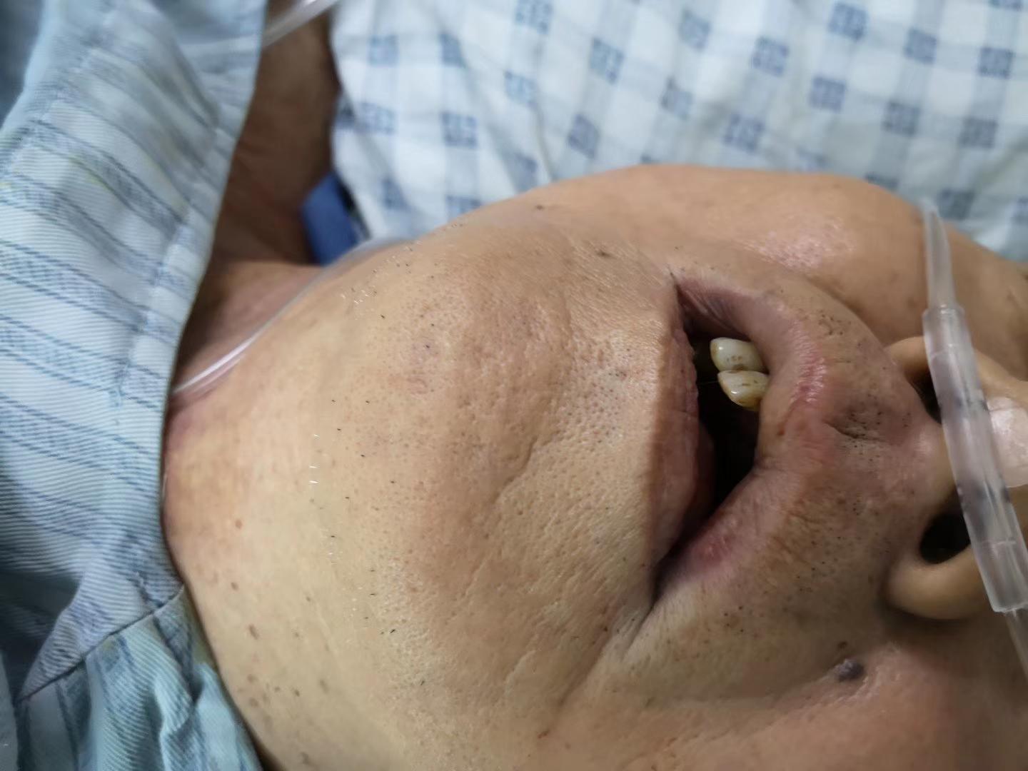 给病人气管插管,气管插管不成功怎么处理