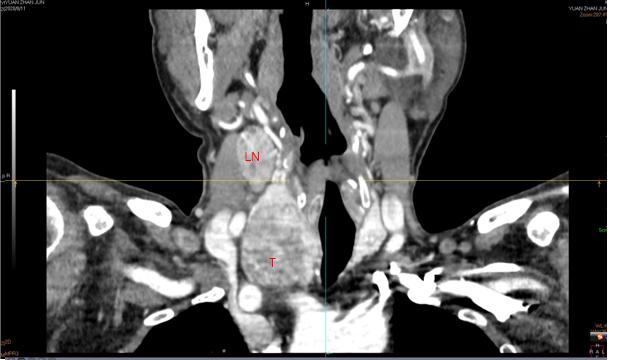 查出来“甲状腺癌”，还能活多久？最详细的治疗介绍如下