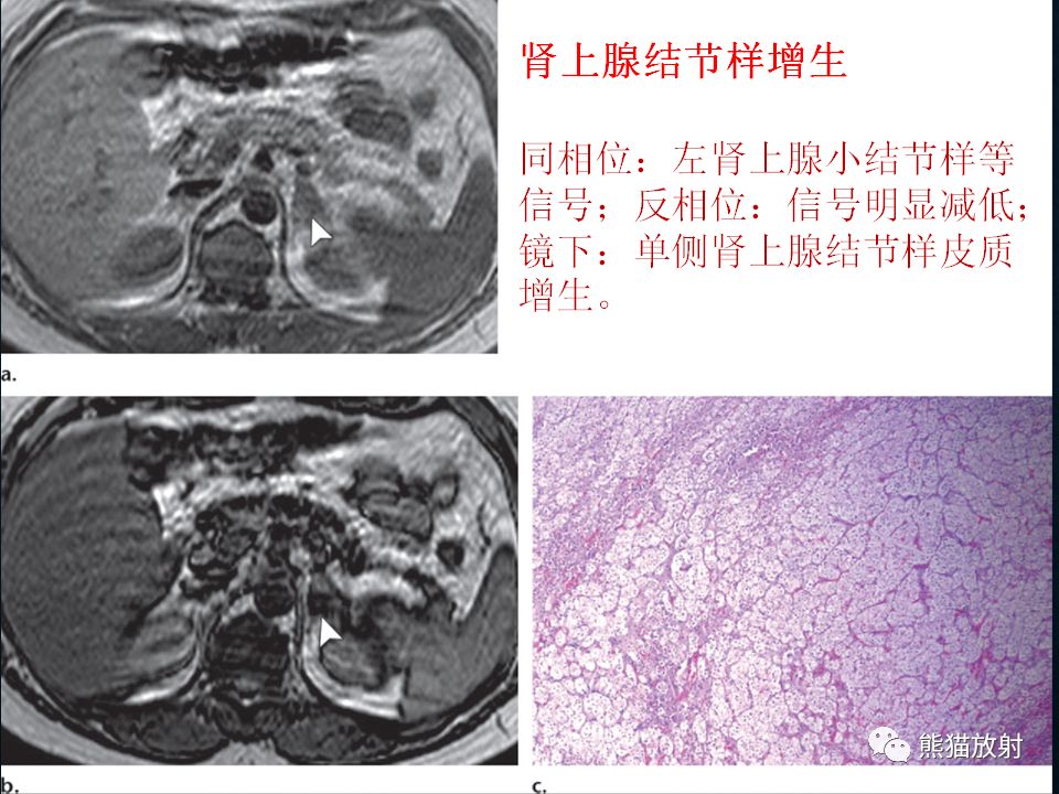 纵隔和肾上腺恶性肿瘤,纵隔性肿瘤位置图