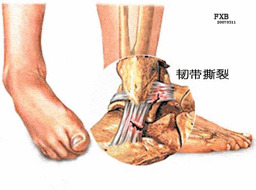 跑步大腿疼和小腿疼有什么区别,跑步之后脚跟疼怎么回事