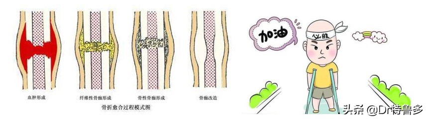 骨折久不愈合做冲击波有效吗,冲击波对骨不愈合有帮助吗