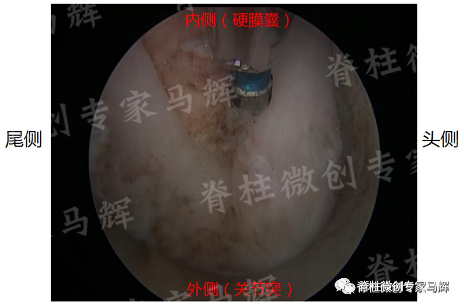 脊椎压迫神经做了微创术后腿麻疼,神经根损伤疼痛治疗