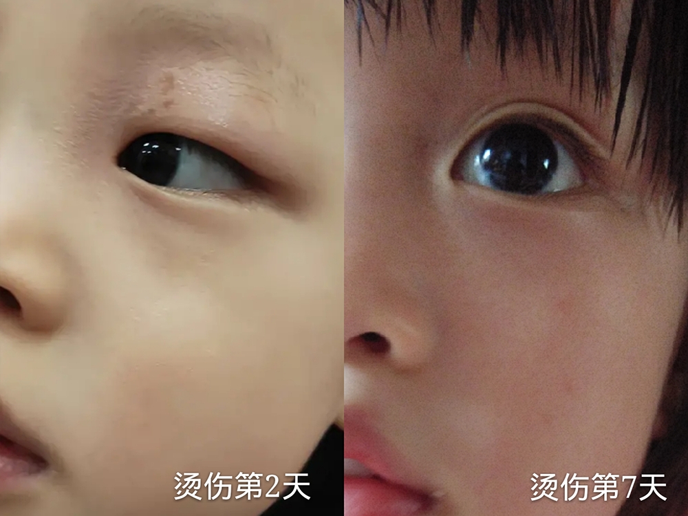 宝宝烫伤这四种处理方法速度收藏,宝宝烫伤最佳的解决方法