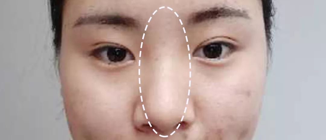 求改善痘痘真实办法,想改变脸上痘痘