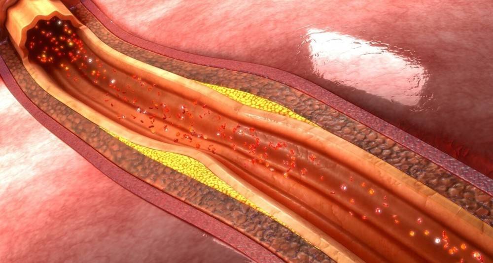 熬夜看球心梗原因,踢球心梗原因