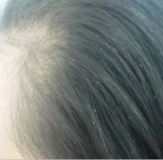 12岁女孩“头皮屑”多到吓人！多次治疗无效，竟是因为爱扎头发？