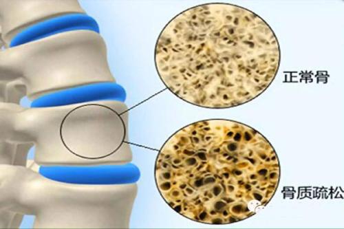 关爱骨病主题活动,宿迁第一人民医院大型义诊