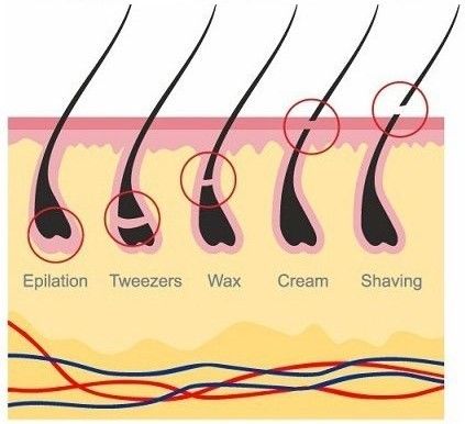 有什么办法可以根除腋毛,怎么样才能根治腋毛