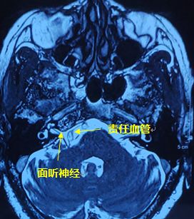 面肌痉挛怎么治右眼跳动,右眼皮跳5天会是面肌痉挛吗