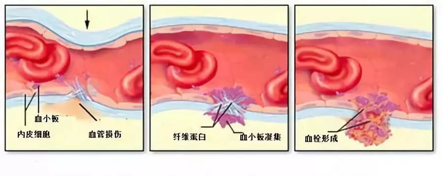 氨甲环酸牙膏可以止血吗,止血敏和氨甲环酸能一块用吗