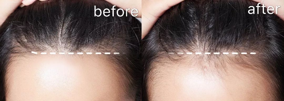 戳进来｜“秃”如其来，除了绝望你还能怎么办？