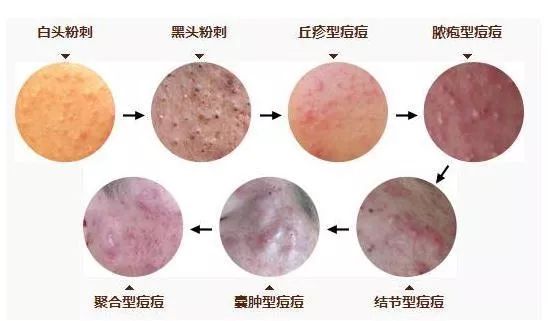 1岁宝宝长痘,1个月的宝宝脸上长痘痘是咋回事