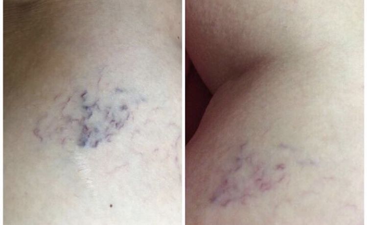 肩颈病用什么贴膏效果好,肩颈疼痛用日本什么膏药好