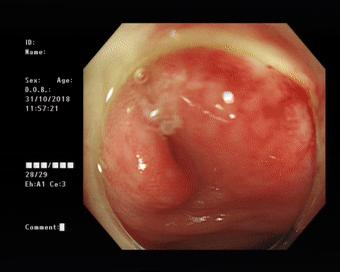 治疗阑尾炎需要手术吗,阑尾炎为什么选择保守治疗呢