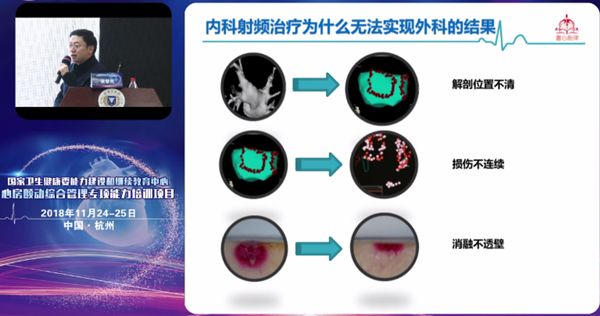 「房颤专项能力培训第10期」浙江大学邵逸夫医院站：导管消融、安全倍增齐头并进