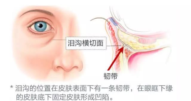 去掉眼袋之后天壤之别,无美颜无滤镜遮泪沟眼袋