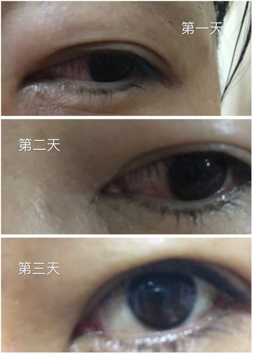 每天喷2下，近视竟然降低了200度？西班牙人都买疯了！还能缓解眼部疲劳，预防老花眼、白内障！