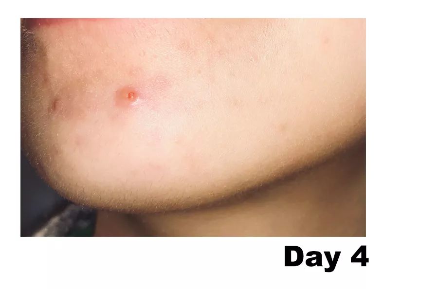 怎么对付闭口,终于找到了对抗失眠的良方