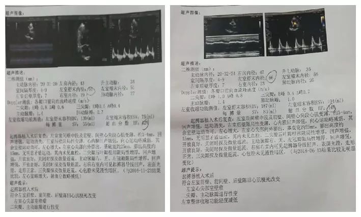 拯救反复心梗发作后心衰患者，积极血运重建和规范药物治疗一个都不能少！