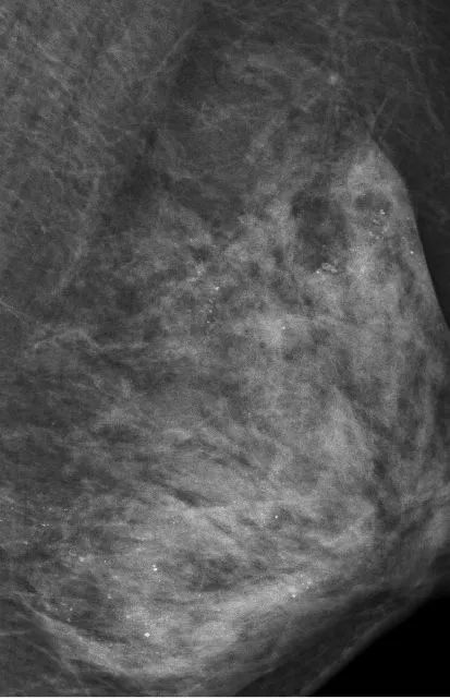 涔虫埧琚垏闄ょ殑妗堜緥,鍒囬櫎涔虫埧妗堜緥