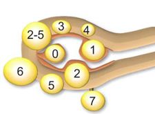 宫腔镜剔除子宫肌瘤大概多少钱,子宫摘除后的科普