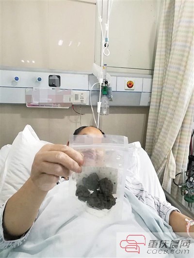 吃了柿子胃里结出了石头,吃柿子吃出胃结石