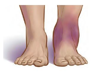 跑步崴脚处理技巧,跑步崴脚了怎么快速恢复