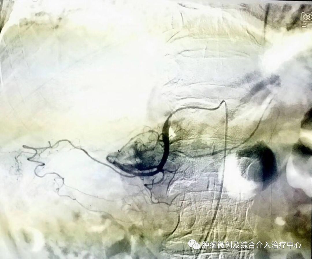 运城第一医院肿瘤介入科专家,运城市第一医院介入科专家