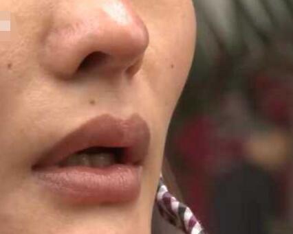 女子花2万多元垫鼻子半年后支架竟要顶穿鼻头