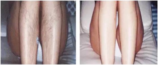 激光美容技术有用吗,解读激光美容的六大疑惑