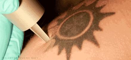 皮秒激光和调q激光哪个先进,皮秒激光消除色素沉着有效吗