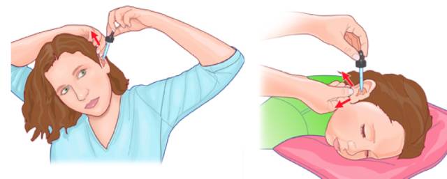 滴耳液后要进行10分钟耳浴啥意思,诺氟沙星滴耳液怎么进行耳浴