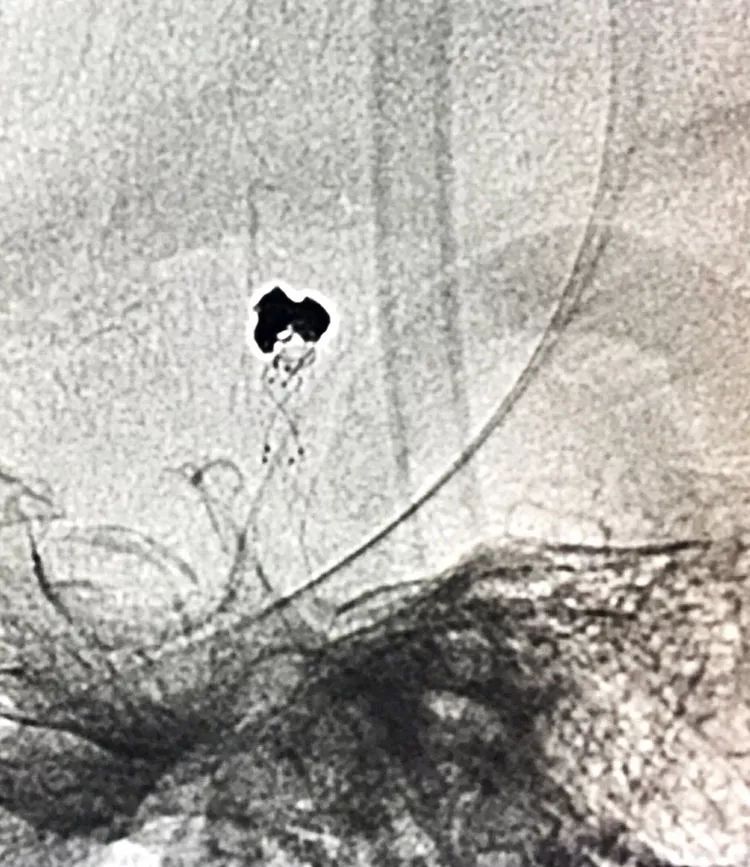 柳暗花明专栏|栓塞颅内动脉瘤时微导管无法穿过LVIS支架网眼怎么办