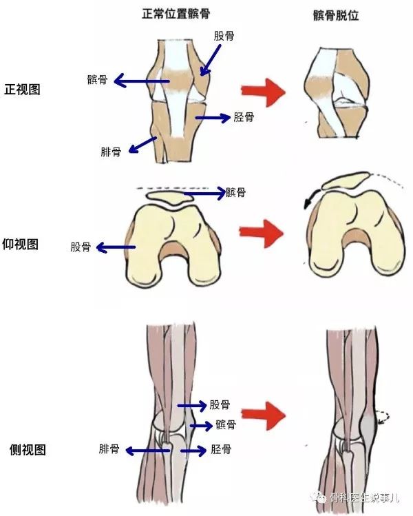关节痛摔腿,关节弯曲痛打直就没事了