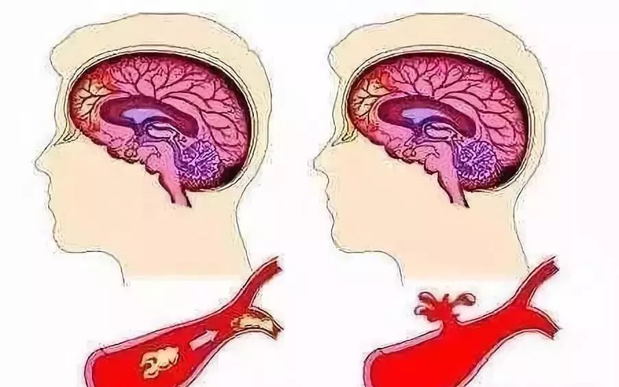 康复锻炼手麻是怎么回事,手麻的治疗思路这5个点要记住