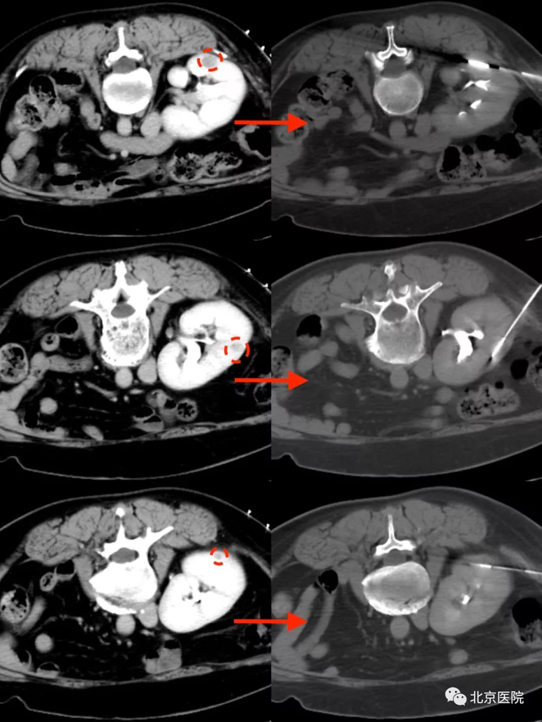 李晓光医生北京医院,北京医院肿瘤微创治疗中心李晓光