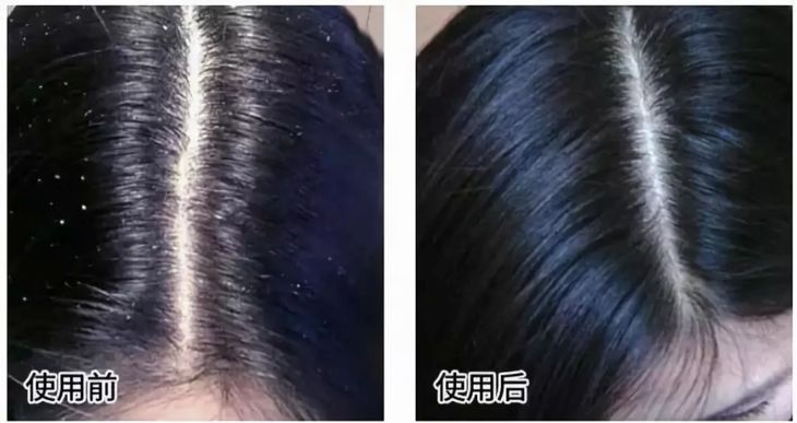 3天不洗头头皮特别多,3天不洗头头皮好臭