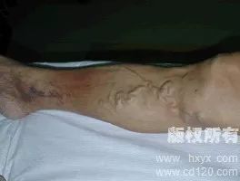 华西静脉曲张专家,华西专家讲静脉曲张