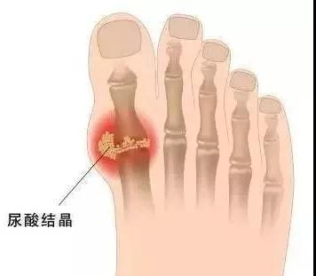 19岁男孩把饮料当水喝，结果脚痛到无法走路！爸爸惊呆……