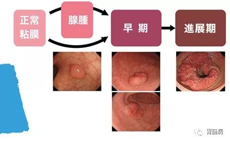 息肉为什么切完还会长,息肉为什么割不净