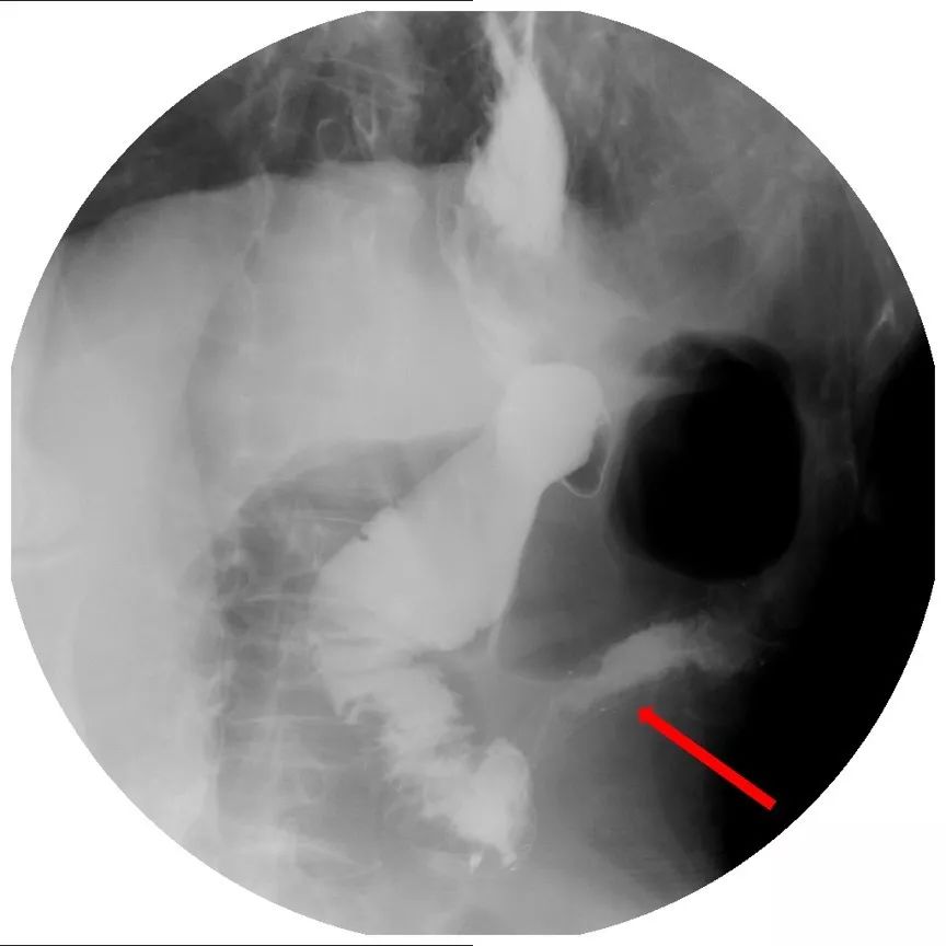 消化道支架置入术,消化道梗阻支架怎么放