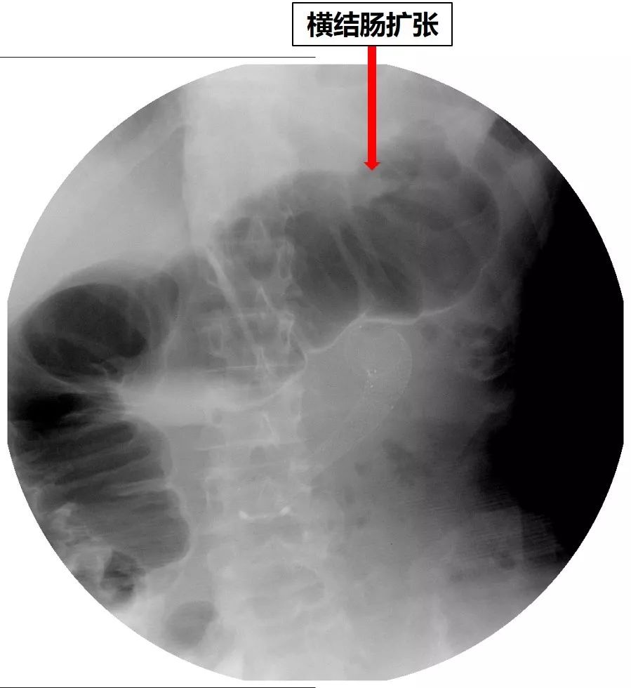 消化道支架置入术,消化道梗阻支架怎么放