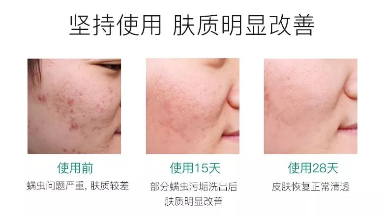 脸上螨虫黑头用完除螨皂好了,脸上有螨虫防螨皂