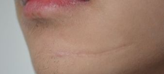 女儿摔破了头流血怎么办,女儿摔破头了我很自责