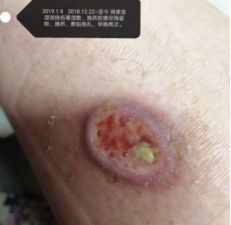 热水袋烧伤,热水袋烧伤起泡怎么处理