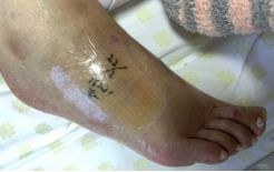 热水袋烧伤,热水袋烧伤起泡怎么处理