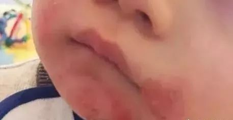 宝宝被口水呛着了怎么办,宝宝被口水呛得脸通红