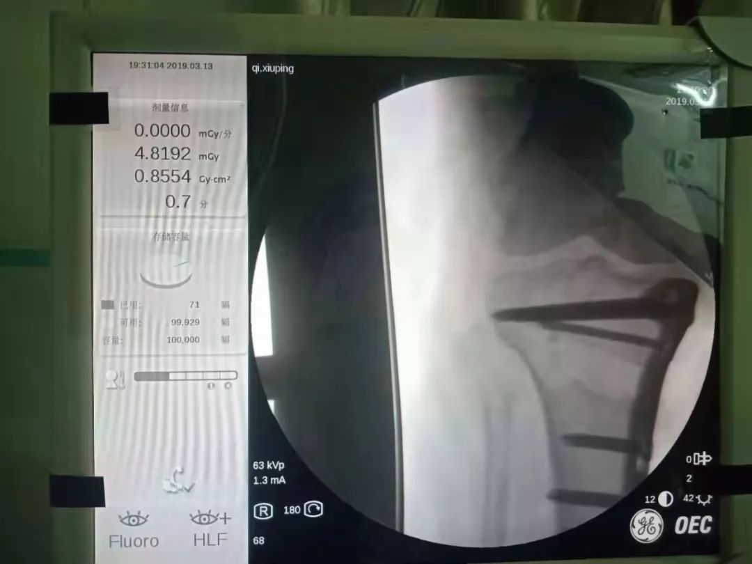 胫骨高位截骨术的适应症,胫骨截骨术hto是微创吗